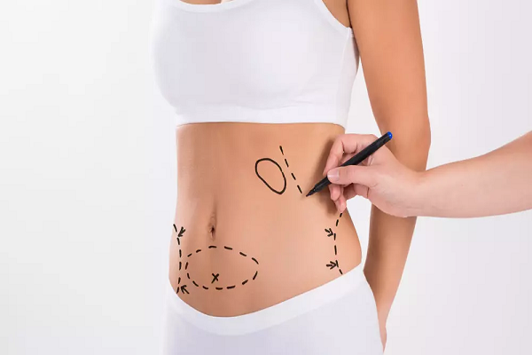 جراحی کوچک کردن شکم زنان