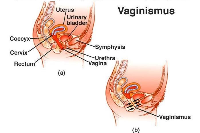 واژینیسموس (دخول دردناک)