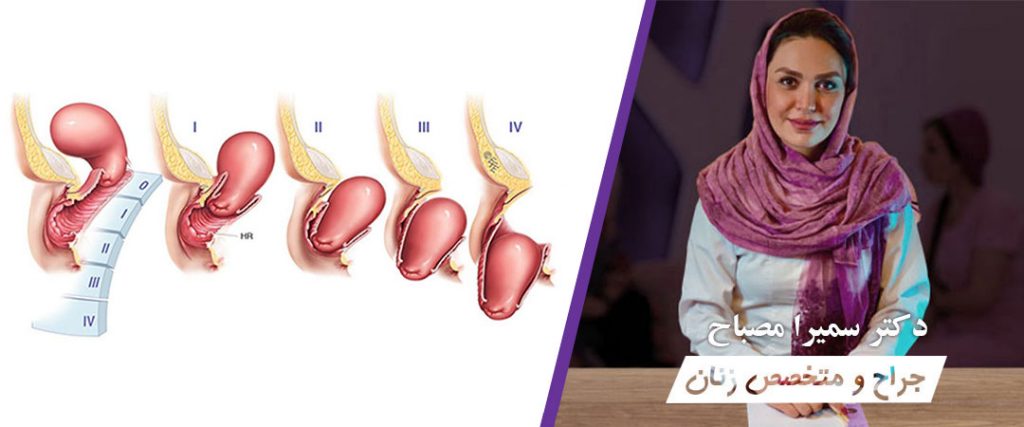 درمان افتادگی مثانه