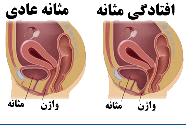 افتادگی مثانه در بانوان