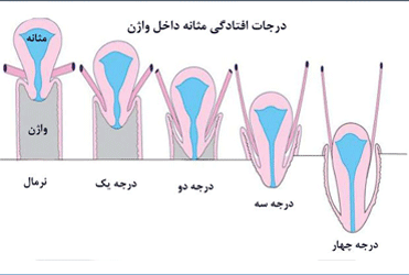 درجات افتادگی مثانه