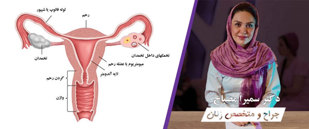 سندرم تخمدان پلی کیستیک