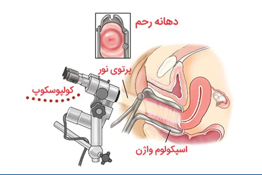کولپوسکوپی رحم و هزینه آن