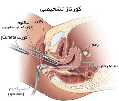 عمل کورتاژ تشخیصی