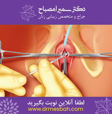 لیفت