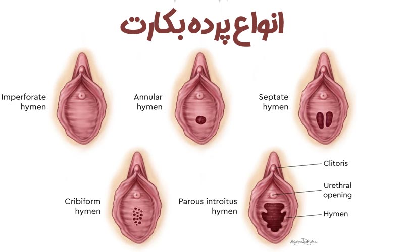 انواع پرده بکارت