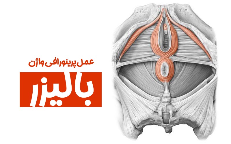 عمل پرینورافی واژن با لیزر