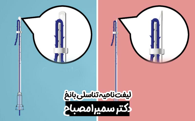 لیفت ناحیه تناسلی با نخ