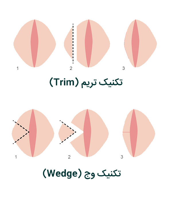 عکس قبل و بعد از عمل لابیاپلاستی