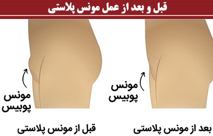 قبل و بعد از عمل مونس پلاستی