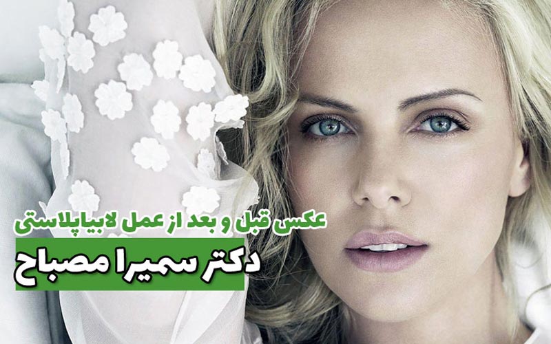 عکس قبل و بعد از عمل لابیاپلاستی