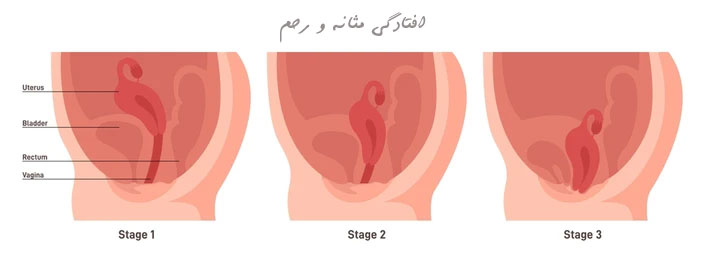 افتادگی مثانه و رحم