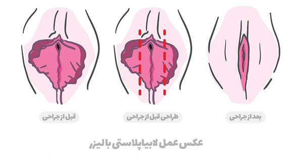 عکس عمل لابیاپلاستی با لیزر