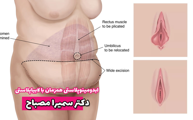 عمل ابدومینوپلاستی همزمان با لابیاپلاستی