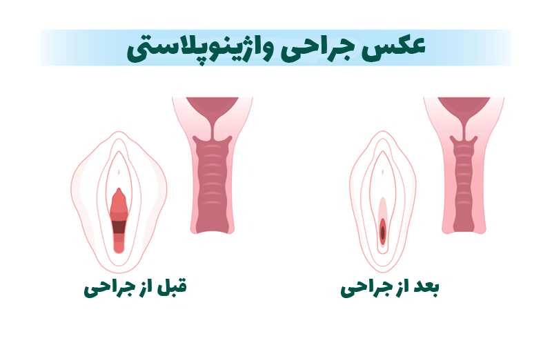 تفاوت پرینورافی و واژینوپلاستی