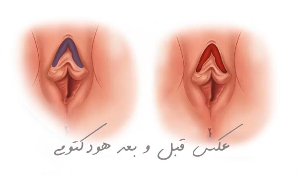 عکس قبل و بعد هودکتومی