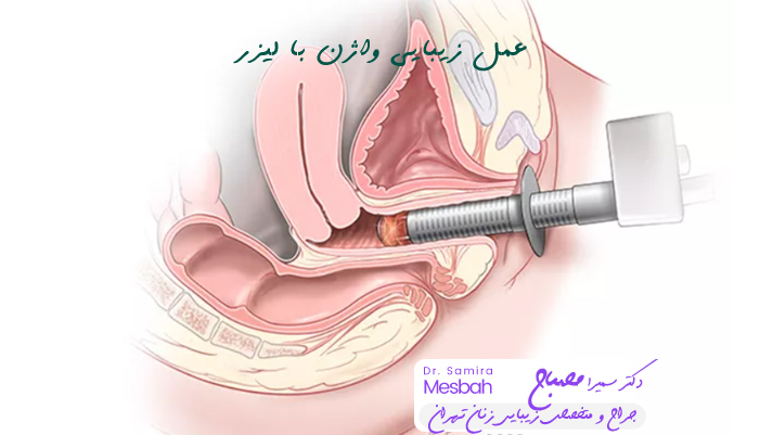 عمل زیبایی واژن با لیزر