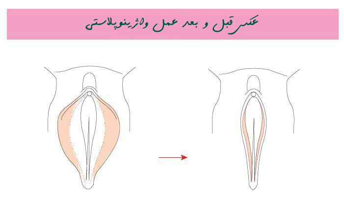 عکس قبل و بعد عمل واژینوپلاستی