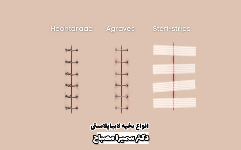 انواع بخیه های مورد استفاده در لابیاپلاستی