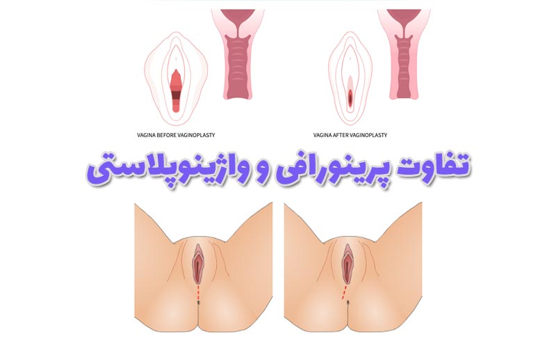 تفاوت پرینورافی و واژینوپلاستی