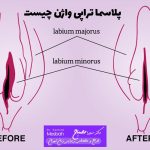 پلاسما تراپی واژن چیست