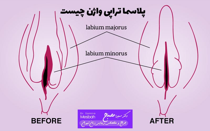 پلاسما تراپی واژن چیست