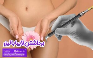 برداشتن لابیا با لیزر