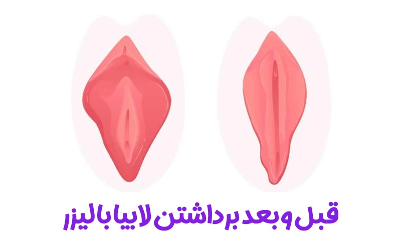 برداشتن لابیا با لیزر 3 عکس قبل و بعد برداشتن لابیا با لیزر