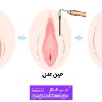 ماندگاری تزریق چربی به واژن