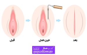ماندگاری تزریق چربی به واژن