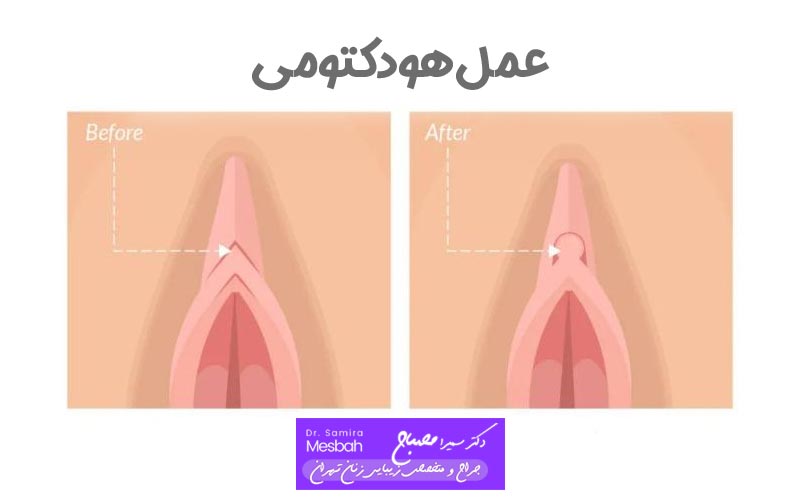 هزینه عمل هودکتومی 3 هزینه عمل لابیاپلاستی و هودکتومی