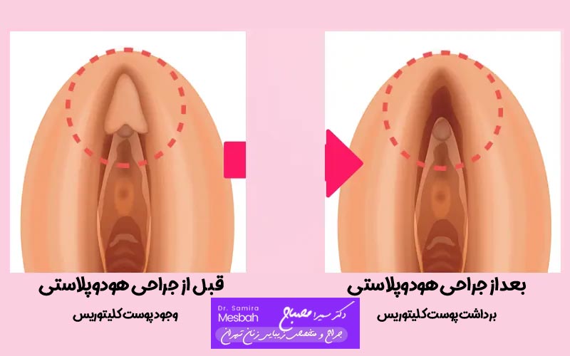 هزینه عمل هودوپلاستی 3 هزینه عمل هودوپلاستی 1404