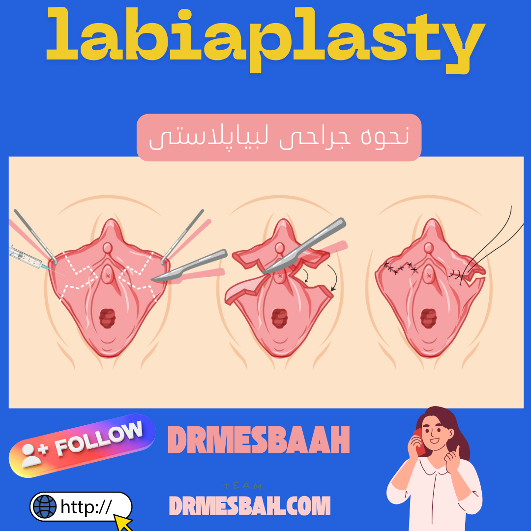 پریود بعد از عمل لابیا 4 _Labiaplasty