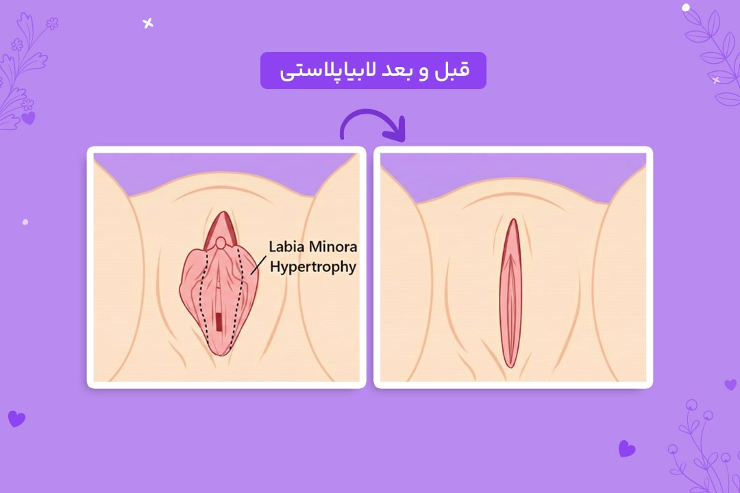 عکس قبل و بعد عمل لابیاپلاستی