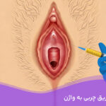 هزینه تزریق چربی به واژن
