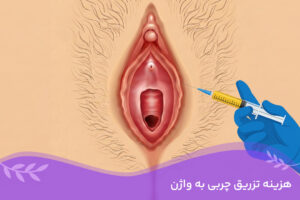 هزینه تزریق چربی به واژن