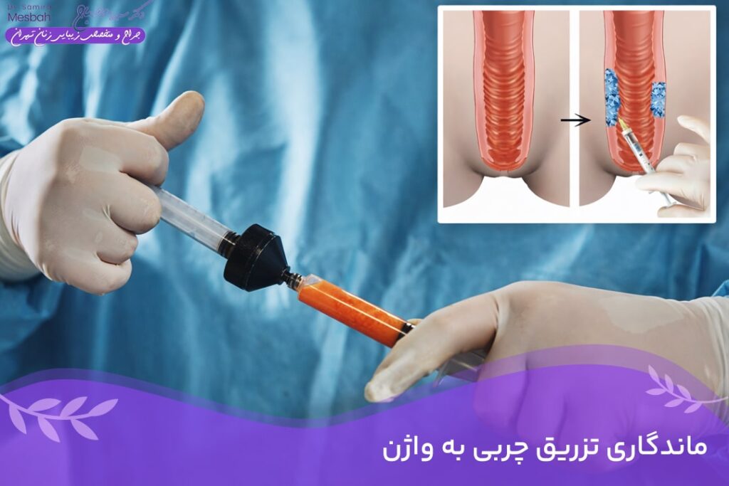 ماندگاری تزریق چربی به واژن 2 ماندگاری تزریق چربی به واژن