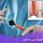 ماندگاری تزریق چربی به واژن