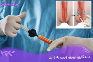 دکتر سمیرا مصباح 6 ماندگاری تزریق چربی به واژن