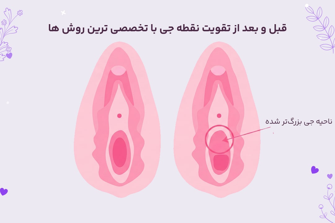 آشنایی با انواع روش های تقویت نقطه جی 3 عکس قبل و بعد تقویت نقطه جی