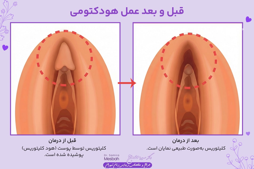 هودکتومی 3 عکس قبل و بعد هودکتومی