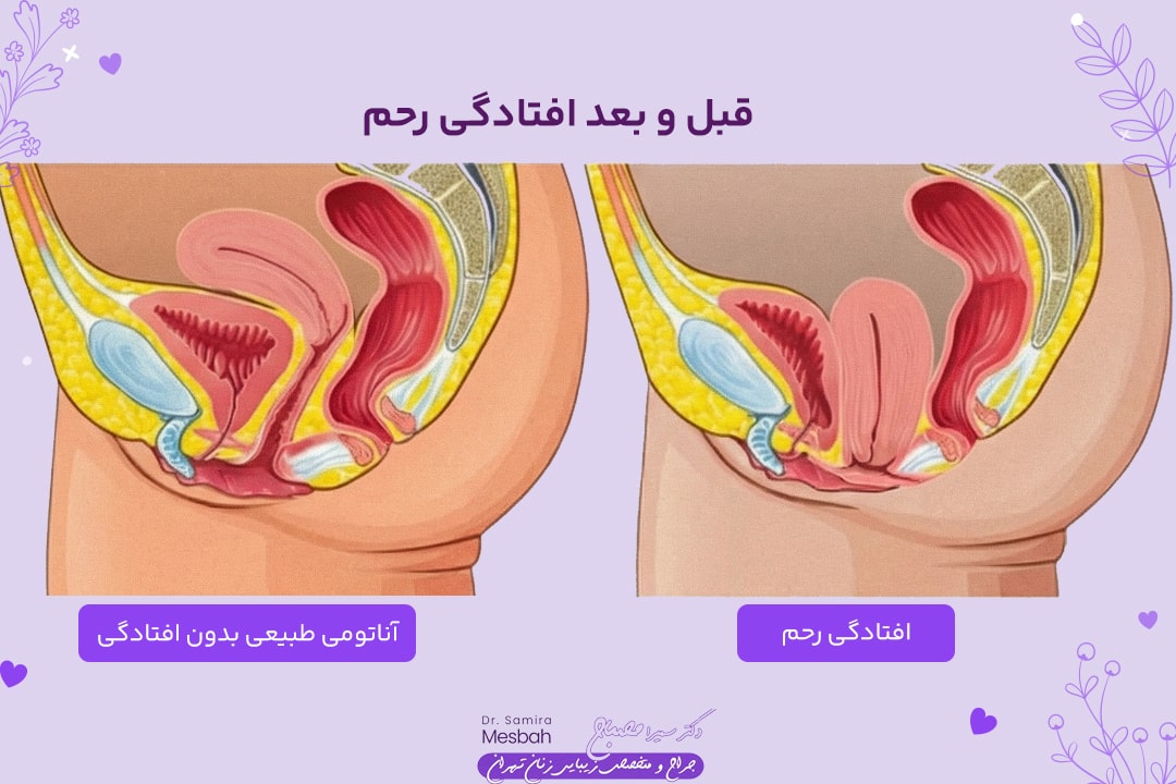 جراحی افتادگی رحم 2 عکس قبل و بعد جراحی افتادگی رحم