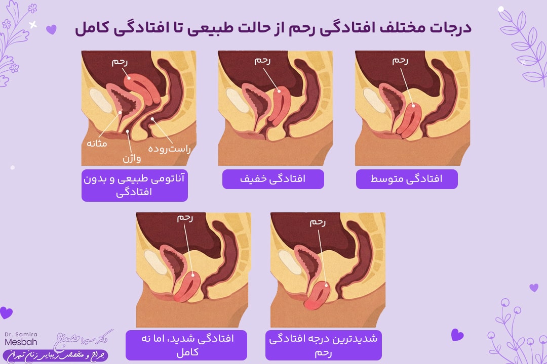 جراحی افتادگی رحم 1 درجات افتادگی رحم