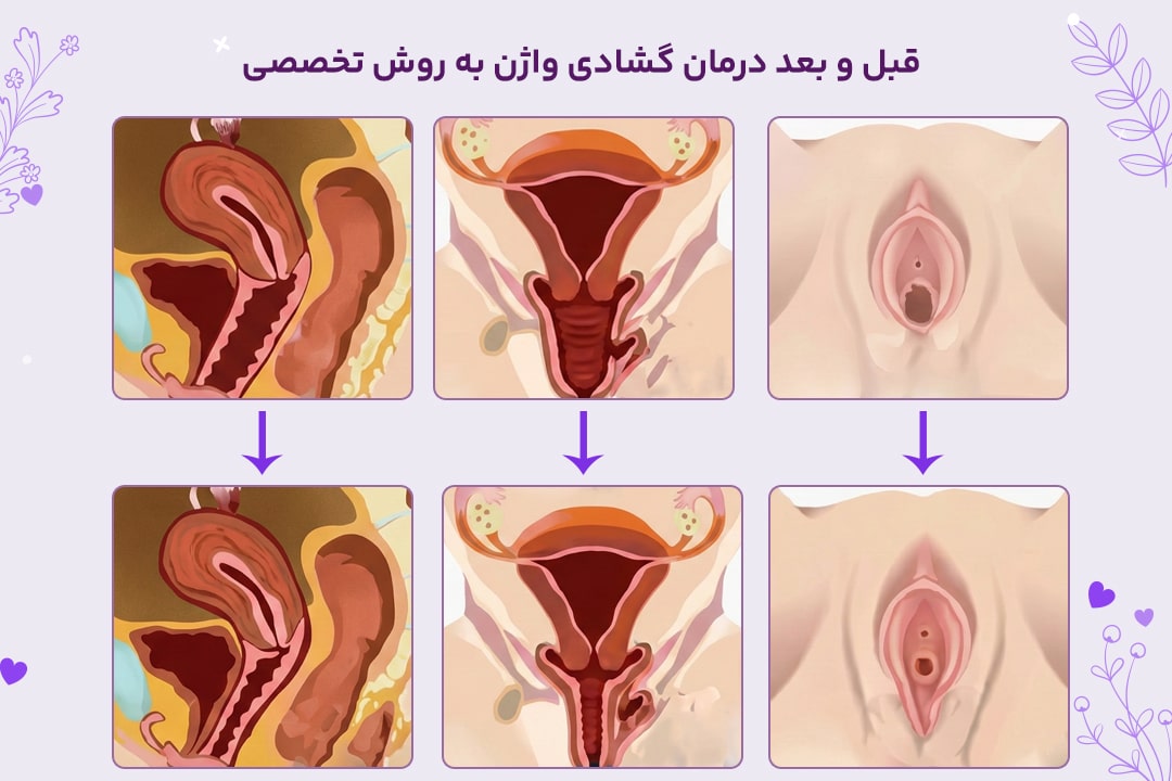 درمان گشادی واژن با دستگاه آر اف