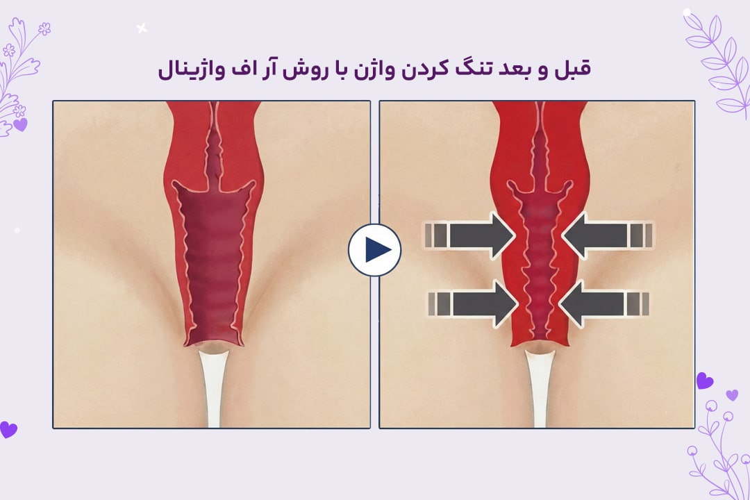 عکس قبل و بعد درمان با ار اف واژینال