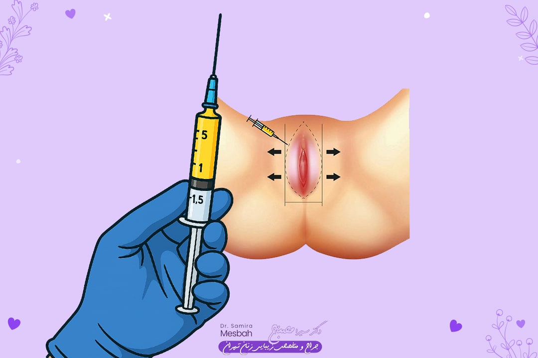 تزریق چربی به واژن 2 تزریق چربی به واژن