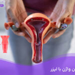 تنگی واژن با لیزر