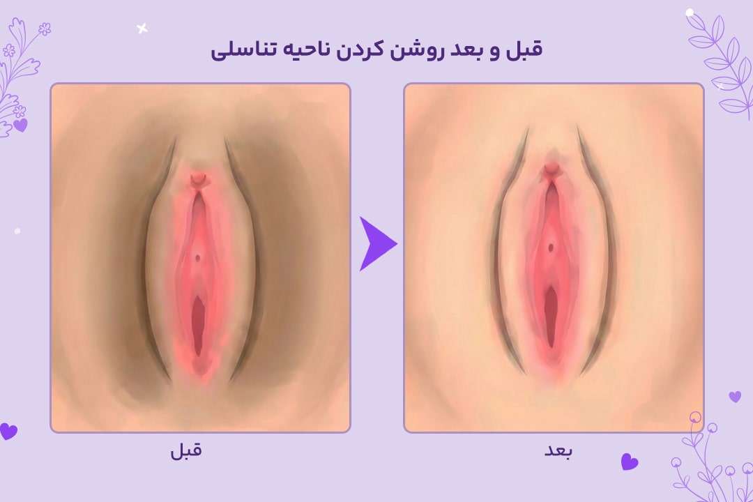 رفع تیرگی واژن 3 قبل و بعد رفع تیرگی واژن