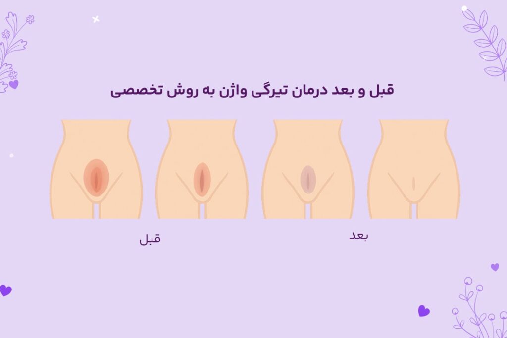 رفع تیرگی واژن با لیزر سفید کننده 6 عکس قبل و بعد وایتنینگ بیکینی