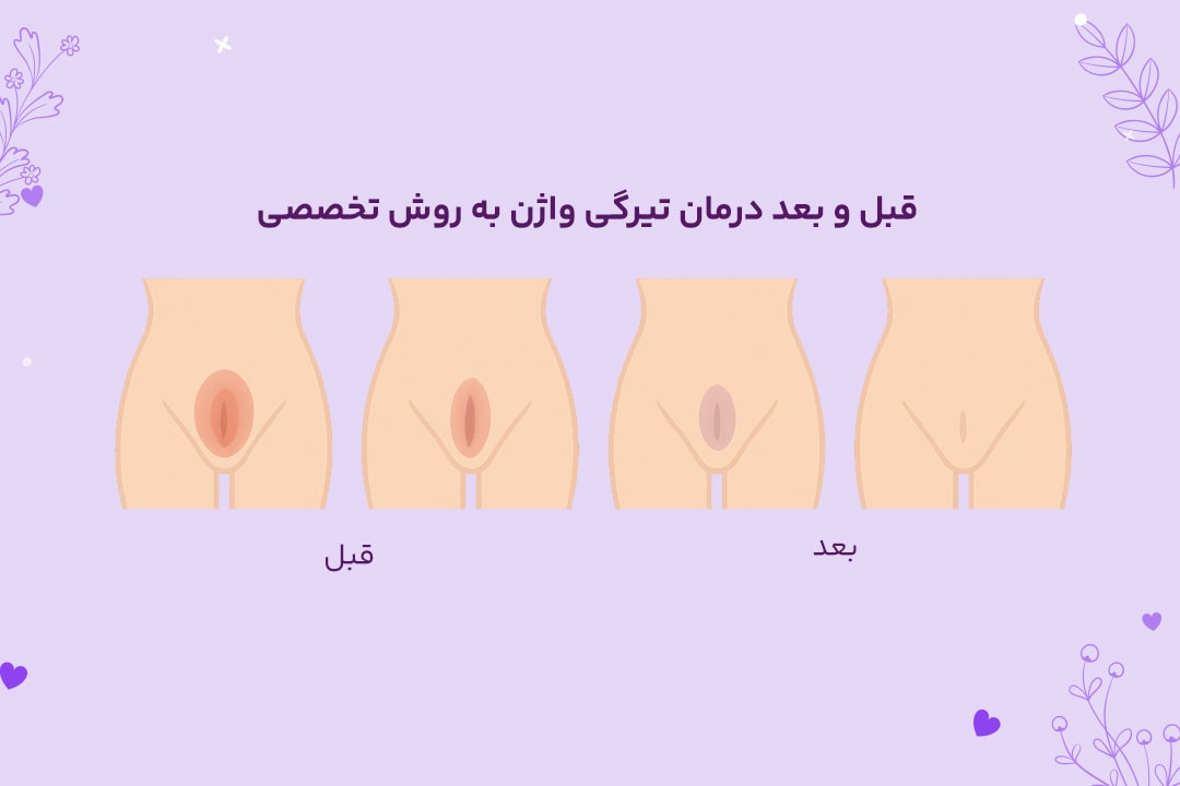 رفع تیرگی واژن 4 عکس قبل و بعد درمان تیرگی واژن